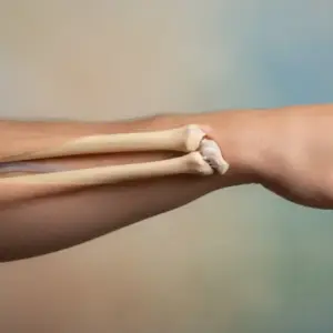 złamanie nasad dalszych kości łokciowej i promieniowej